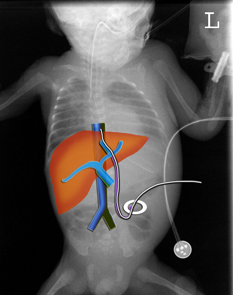 RARE UMBLICAL VEIN SURGERY SAVES WOMEN’S LIFE IN DUBAI